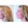 What is Silhouette Soft: the lunchtime facelift explained